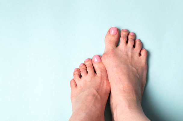 Tratamiento ortopédico. Deformación de Valgus de zapatos estrechos
 - Foto, Imagen