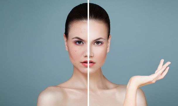 Young Female Face with Skin Problem and Clear Skin - 写真・画像