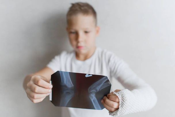 El chico con la mano rota mira la radiografía. Rayos X en las manos de un niño triste con un brazo roto
. - Foto, Imagen