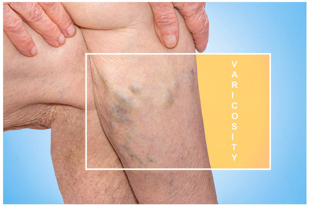 Varicose veins on a female legs - Photo, Image