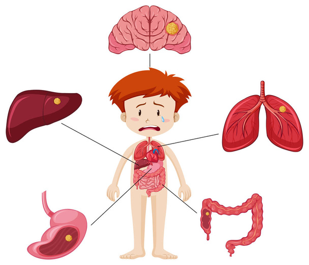 少年と臓器疾患のさまざまな部分を示す図 - ベクター画像
