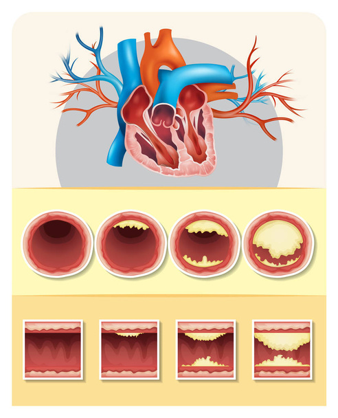 Diagram znázorňující tuku v lidském srdci - Vektor, obrázek