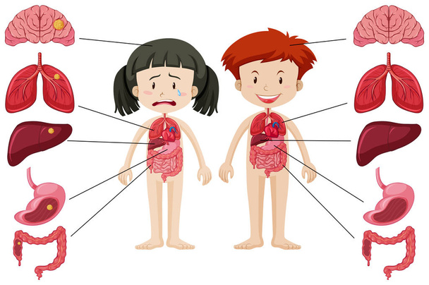 Chica y niño con diferentes cuerpos sanos y malsanos
 - Vector, imagen
