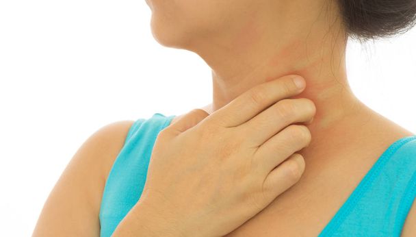 Рой сыпь красный зуд кожных заболеваний у женщин с помощью руки царапин. Концепция с здравоохранением и медициной
. - Фото, изображение