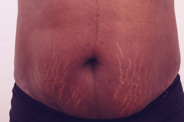 太った女性のストレッチ マークと腹に傷 - 写真・画像
