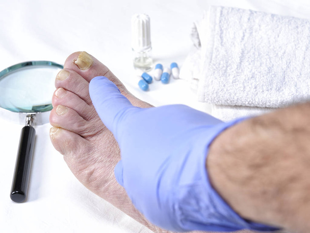 Онихомикоз - заболевание ногтей, вызванное действием патогенных микроорганизмов
. - Фото, изображение