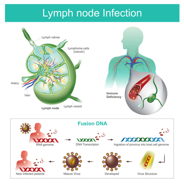 Лімфатичні вузли інфіковані Провал імунної системи, б
 - Вектор, зображення
