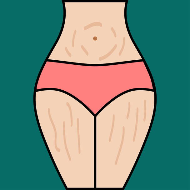 Striae on thighs of woman - Vector, Image