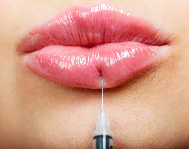 美しい女性の唇とフィラー注射器のクローズ アップ ショット - 写真・画像