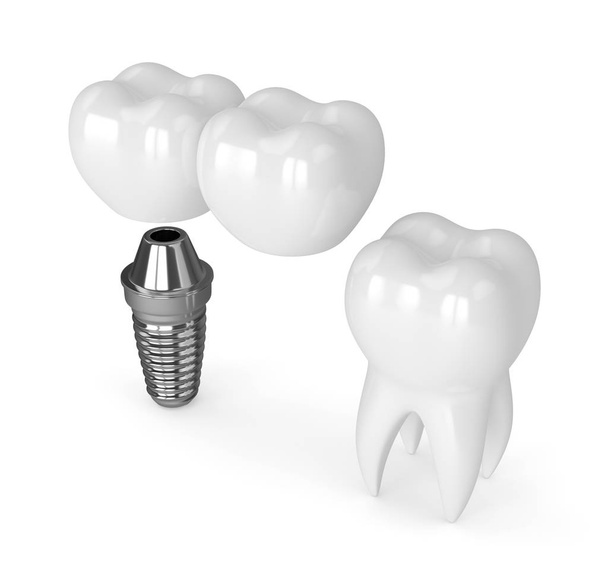 3d render of implant with dental cantilever bridge  - Fotó, kép