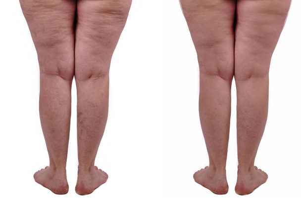 vrouwelijke benen met cellulitis voor en na behandeling. Geïsoleerd  - Foto, afbeelding