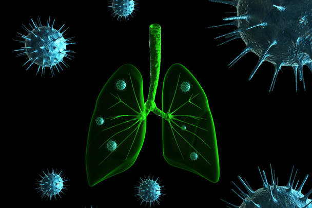 Infezione da virus nei polmoni
 - Foto, immagini