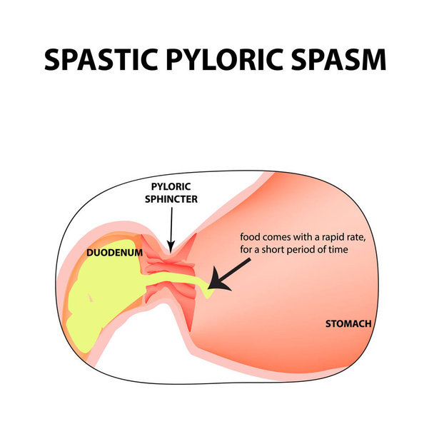 spasms of the pylorus. Pylorospasm. Spastic Pyloric sphincter of the stomach. Infographics. Vector image on isolated background - Vector, Image