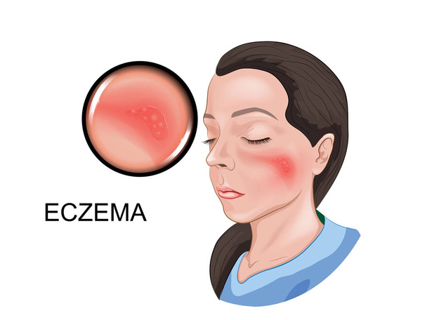 Eczema - Vettoriali, immagini