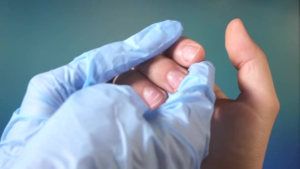 witte vlekjes op de nagels van een mans handen - Video
