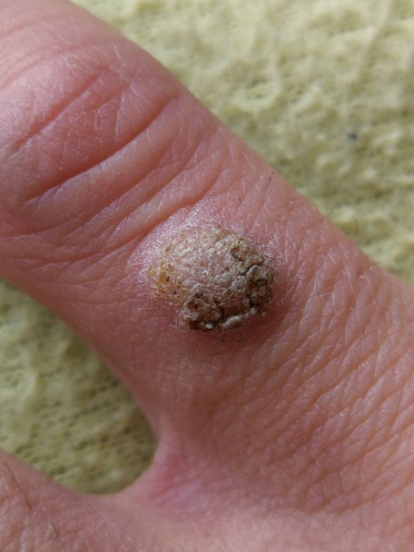 Wart no dedo da mão, close-up - Foto, Imagem