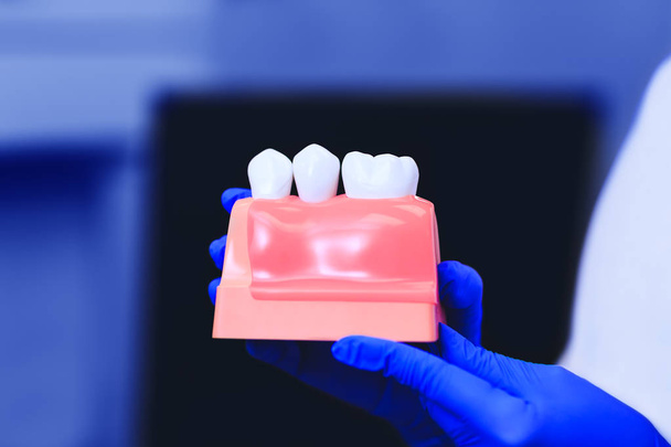 Modell der Zähne mit Zahnimplantat in den Händen eines echten Arztes, Nahaufnahme. Zahnsanierung. Installation des Zahnimplantats. Zahnersatz. künstliche Zähne mit Stahlstift. Mundpflege und Zahnheilkunde. - Foto, Bild