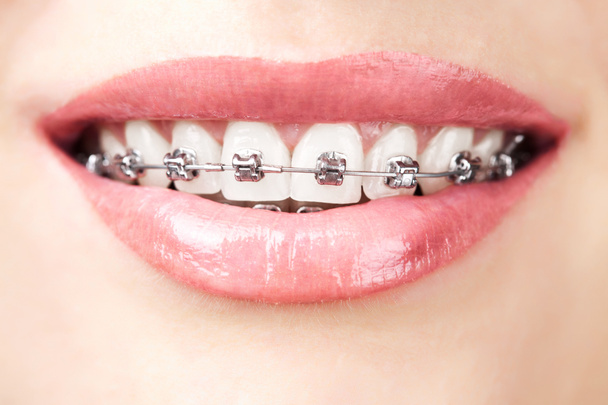 Hampaat hammasraudoilla
 - Valokuva, kuva