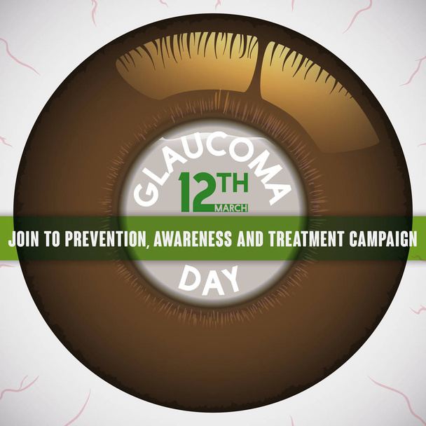 Ojo enfermo con córnea edematosa que promueve campaña preventiva contra el glaucoma, ilustración vectorial
 - Vector, Imagen