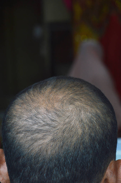 capelli calvi sulla testa
 - Foto, immagini