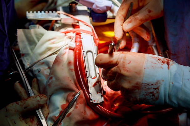 chirurgie à cœur ouvert pour la chirurgie coronarienne
 - Photo, image
