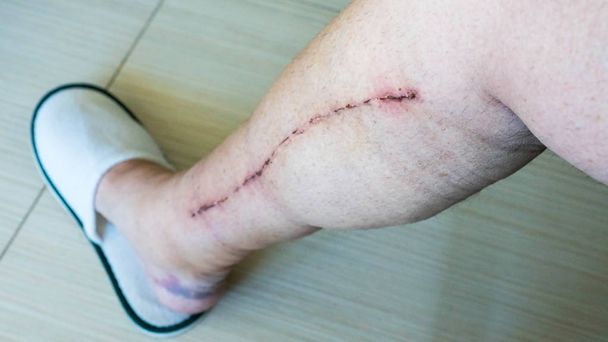 Enfoque selectivo de la pierna humana masculina con cicatriz de cirugía cardíaca de enfermedad arterial coronaria
 - Foto, imagen