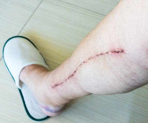 Foco Seletivo de perna humana masculina com cicatriz de cirurgia cardíaca de doença arterial coronariana
 - Foto, Imagem