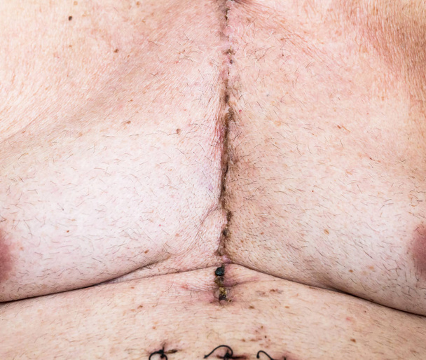 Surgical scar from cardiac surgery of coronary artery disease - Photo, Image