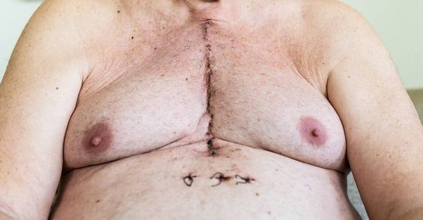 Cicatrice chirurgica da chirurgia cardiaca di malattia coronarica
 - Foto, immagini