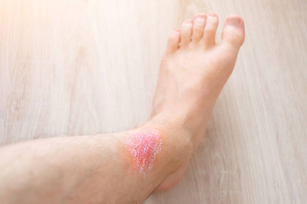 Skin irritation of feet, applied cream on the skin from irritation. - Photo, Image