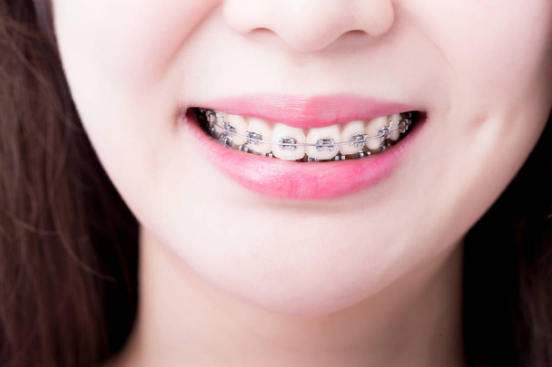 Nahaufnahme einer jungen Frau mit Zahnspange - Foto, Bild