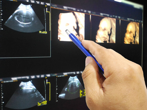 Soft and blurry image Hand doctor holding a pen on image Ultrasound 3D/4D of baby in mother's womb. - Photo, Image