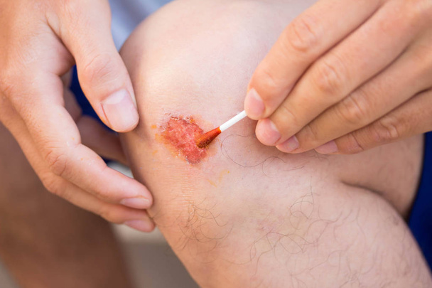 Mann behandelt Verletzung oder Wunde am Knie mit rotem Medikament - Foto, Bild