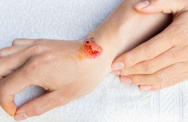 Человек показывает повреждения или раны на руке после несчастного случая
 - Фото, изображение