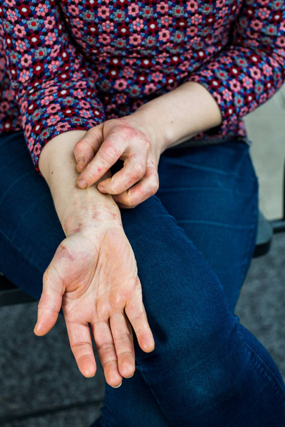 Jonge vrouw met droog en gestresst rode dyshidrotic eczeem gedekt handen - Foto, afbeelding