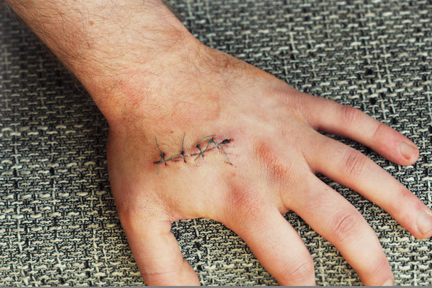 Manos en la herida de sutura oscura en la mano. Concepto de dolor de accidente
 - Foto, imagen