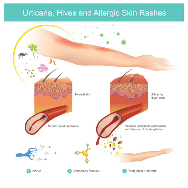 Orticaria, orticaria ed eruzioni cutanee allergiche. Illustrazione
. - Vettoriali, immagini