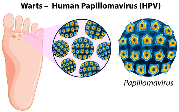 Schema che mostra le verruche nel piede umano
 - Vettoriali, immagini
