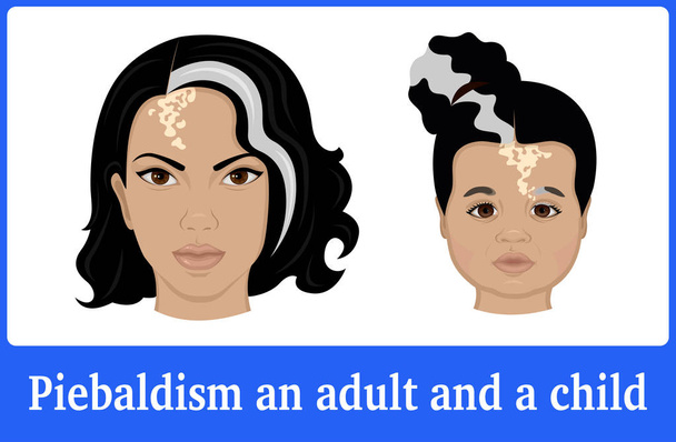 Εικόνα από τα συμπτώματα της piebaldism σε μια νεαρή γυναίκα και ένα μικρό κορίτσι - Διάνυσμα, εικόνα