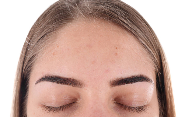 Mujer joven con problemas de acné sobre fondo blanco - Foto, Imagen