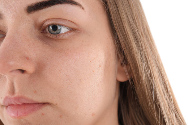 Young woman with acne problem on white background - Foto, afbeelding