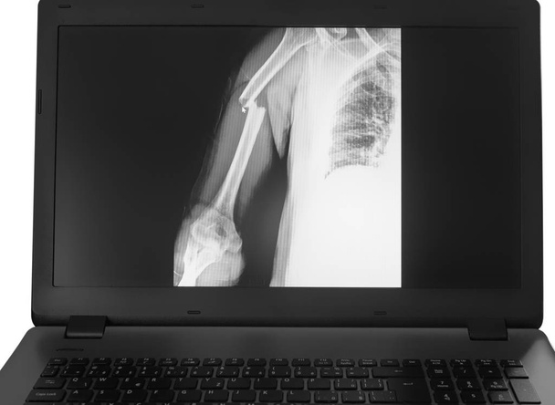 Imagen de rayos X del brazo roto en el monitor de la PC
 - Foto, imagen