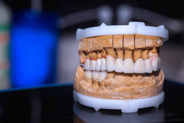 Protesi dentaria in porcellana dentale in dentista
 - Foto, immagini