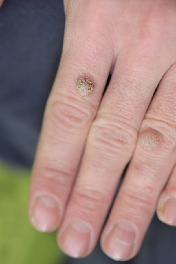 Verruche sul dito della mano, da vicino - Foto, immagini