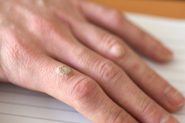 Verrugas en el dedo de la mano, cerca - Foto, imagen