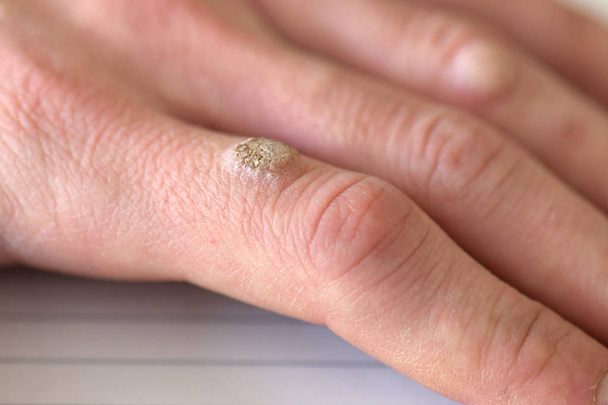 Verruche sul dito della mano, da vicino - Foto, immagini