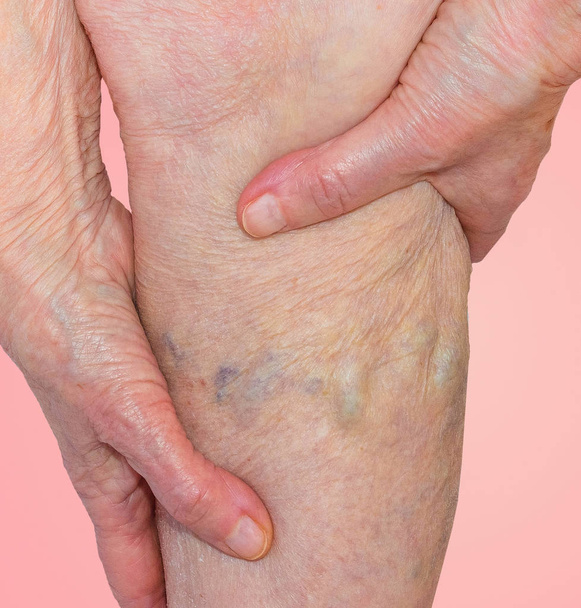 die Krampfadern an den Beinen einer alten Frau auf blau - Foto, Bild
