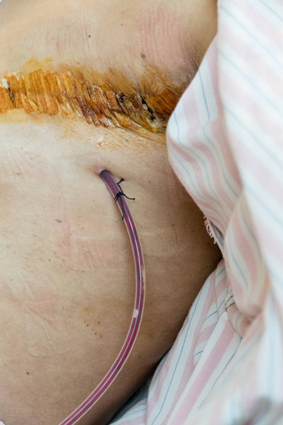 Surgical drain and suture on woman post surgery - Fotografie, Obrázek