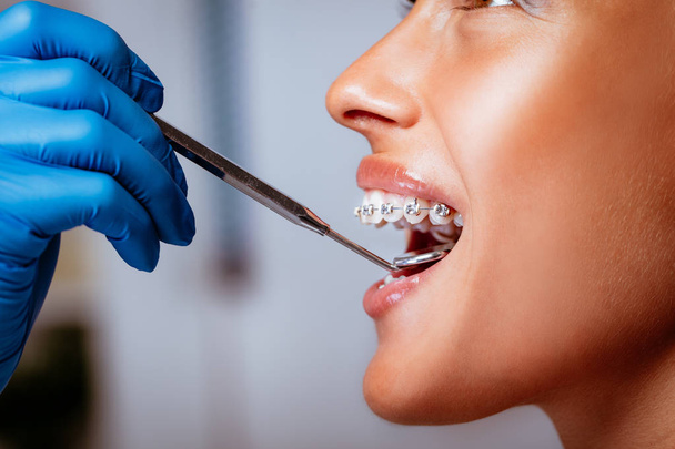 A fogorvosi ellenőrzés fogszabályozó fogorvosi tükörrel, a fiatal nő beteg részlete.  - Fotó, kép