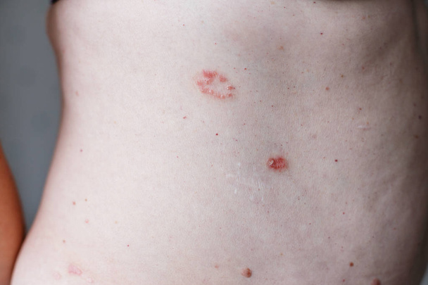 Psoriasis skin. Psoriasis is an autoimmune disease that affects the skin cause skin inflammation red and scaly. Eczema skin - 写真・画像